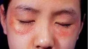 什么是干敏？什么是油敏？什么是激素敏？你必须了解的皮肤过敏真相！