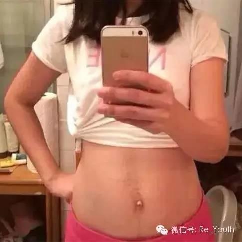 BODY Spa机如何轻松去掉妊娠纹