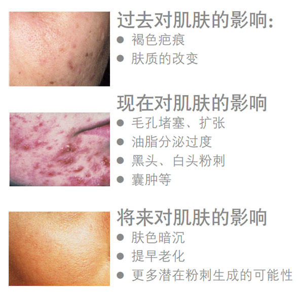 NU SKIN如新®净肤系列—远离痘痘