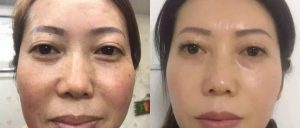 【客户见证】如新让我找回健康，美丽和自信–杨玉平