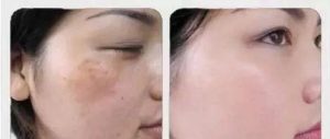脸上长斑如何解决，Nuskin如新还肌肤一份“清白”