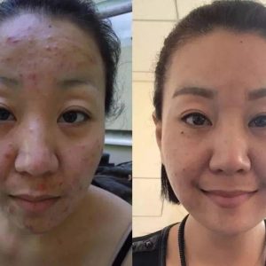 【每日一星】战痘10年～逆袭成女神