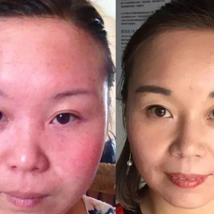 【每日一星】敏感肌终于变健康