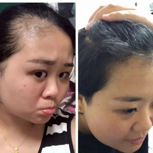 【逆龄】脱发的看这里
