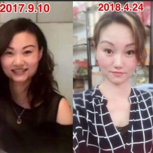 【逆龄】离V脸的梦想更近了一步