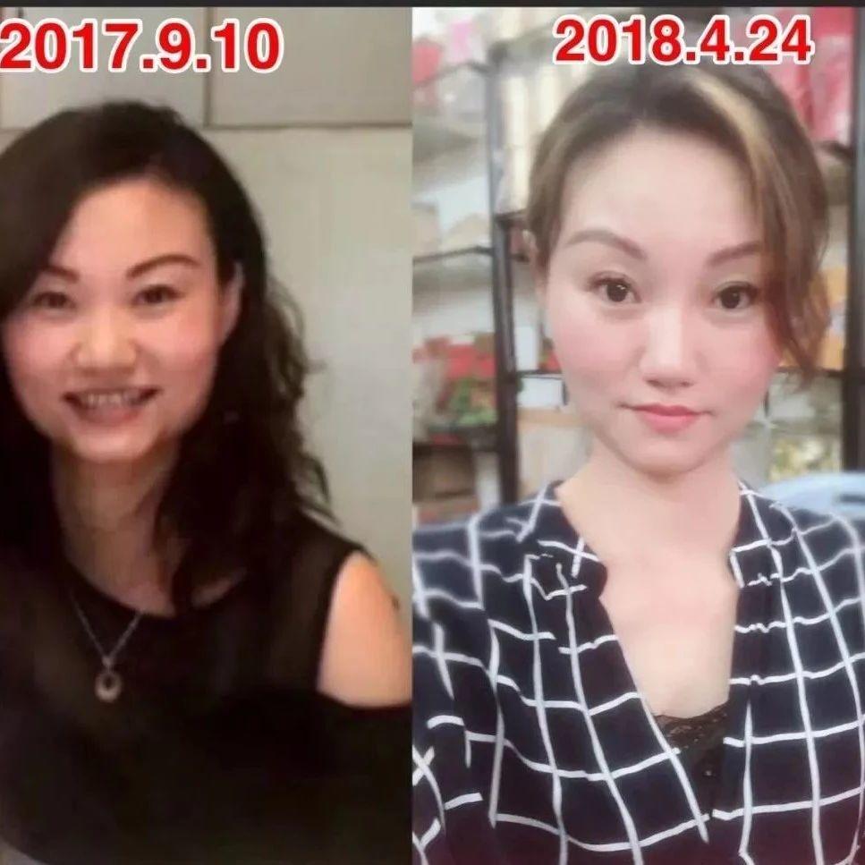 【逆龄】离V脸的梦想更近了一步