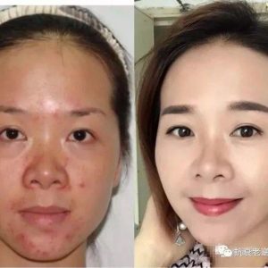 【逆龄】“痘痘公主”大变身